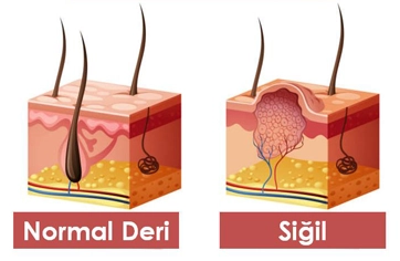 Genital Siğil Tedavisi
