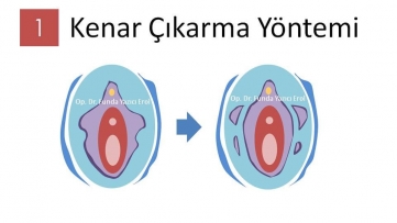Labioplasti Ameliyatı Kenar Çıkarma
