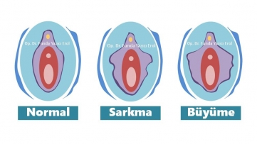 İç Dudak Sarkması ve Büyümesi