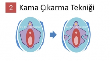 Labioplasti Ameliyatı Kama Çıkarma