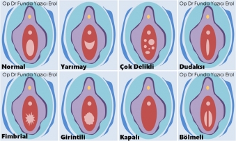 Kızlık Zarı Şekilleri, Türleri, Çeşitleri